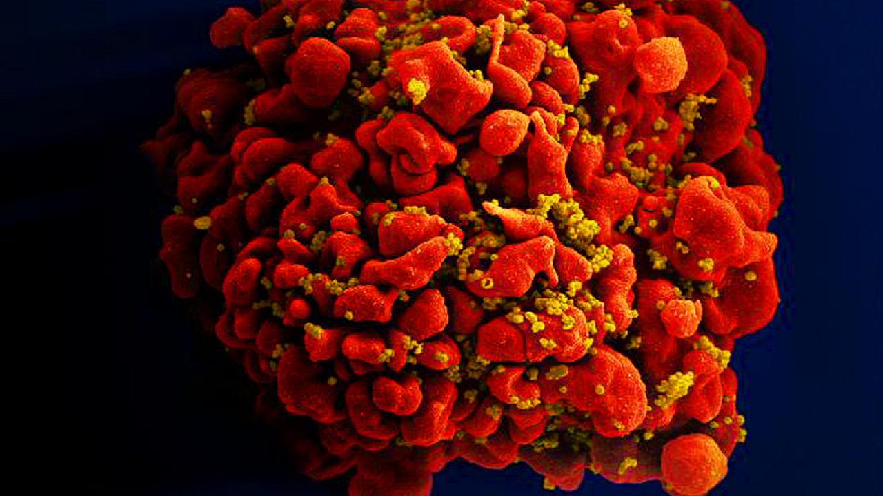 Remédio contra o câncer ajuda a expulsar vírus ‘adormecido’ do HIV