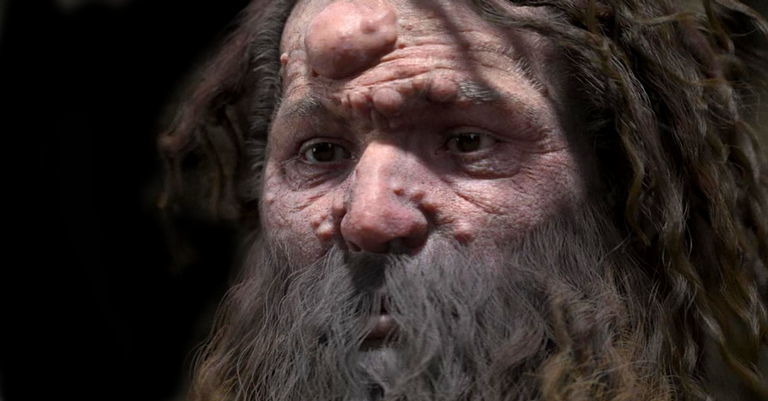 Reconstrução do Homem de Cro-Magnon revela doença genética
