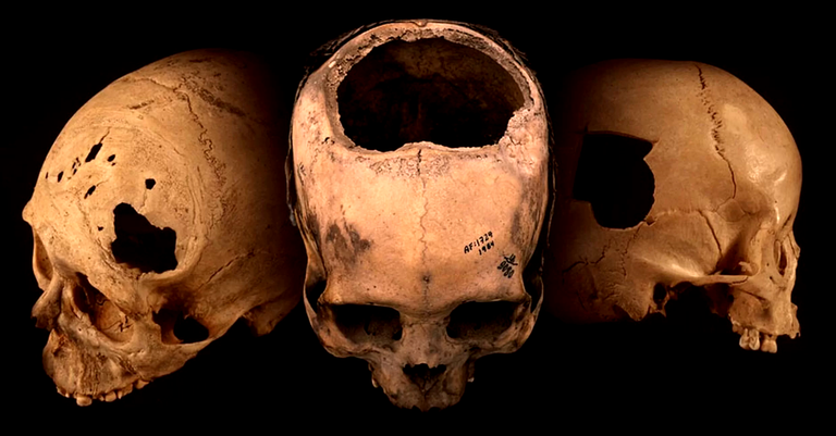 Incas mataram menos por trepanação do que médicos da Guerra Civil Americana, aponta estudo