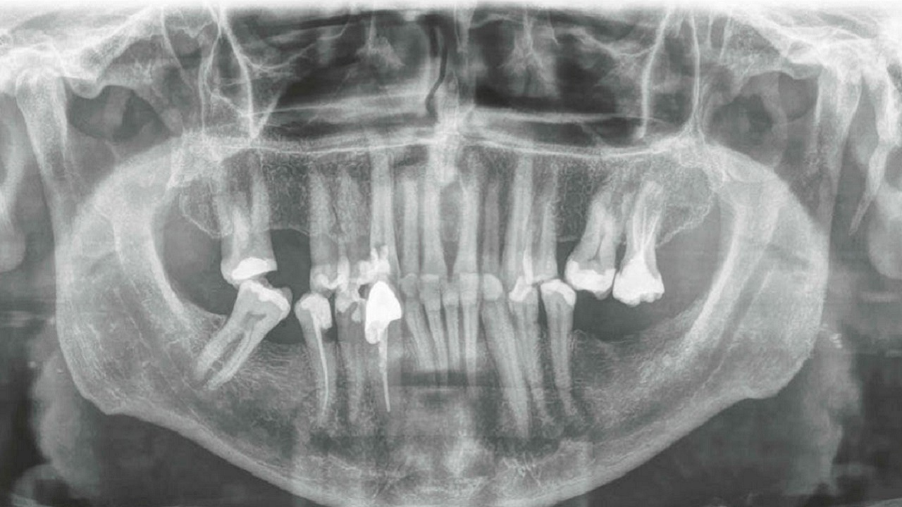 Dentista extrai maior dente da História e entra no livro dos recordes. Confira a imagem!