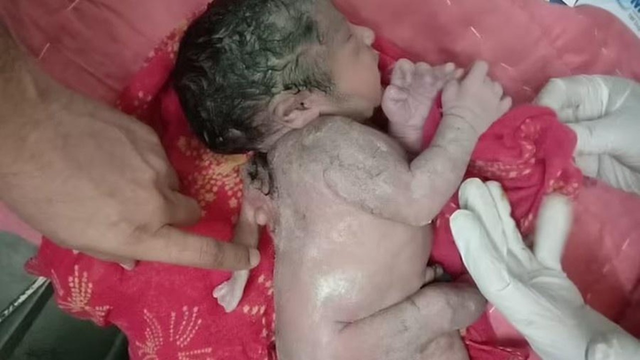 Em caso raro, bebê nasce na Índia com terceira mão nas costas