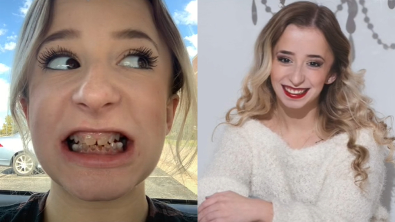 Jovem com dentes ‘transparentes’ faz implante e ganha novo sorriso