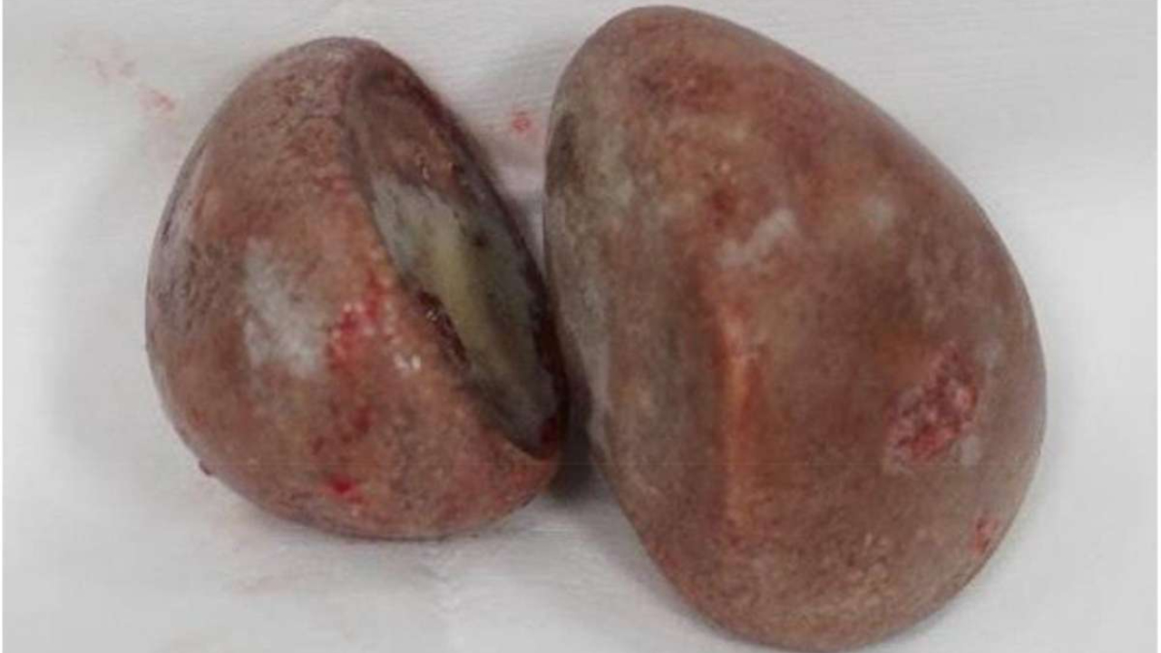 Médicos encontram ‘pedras’ com 5 cm em vagina de paciente