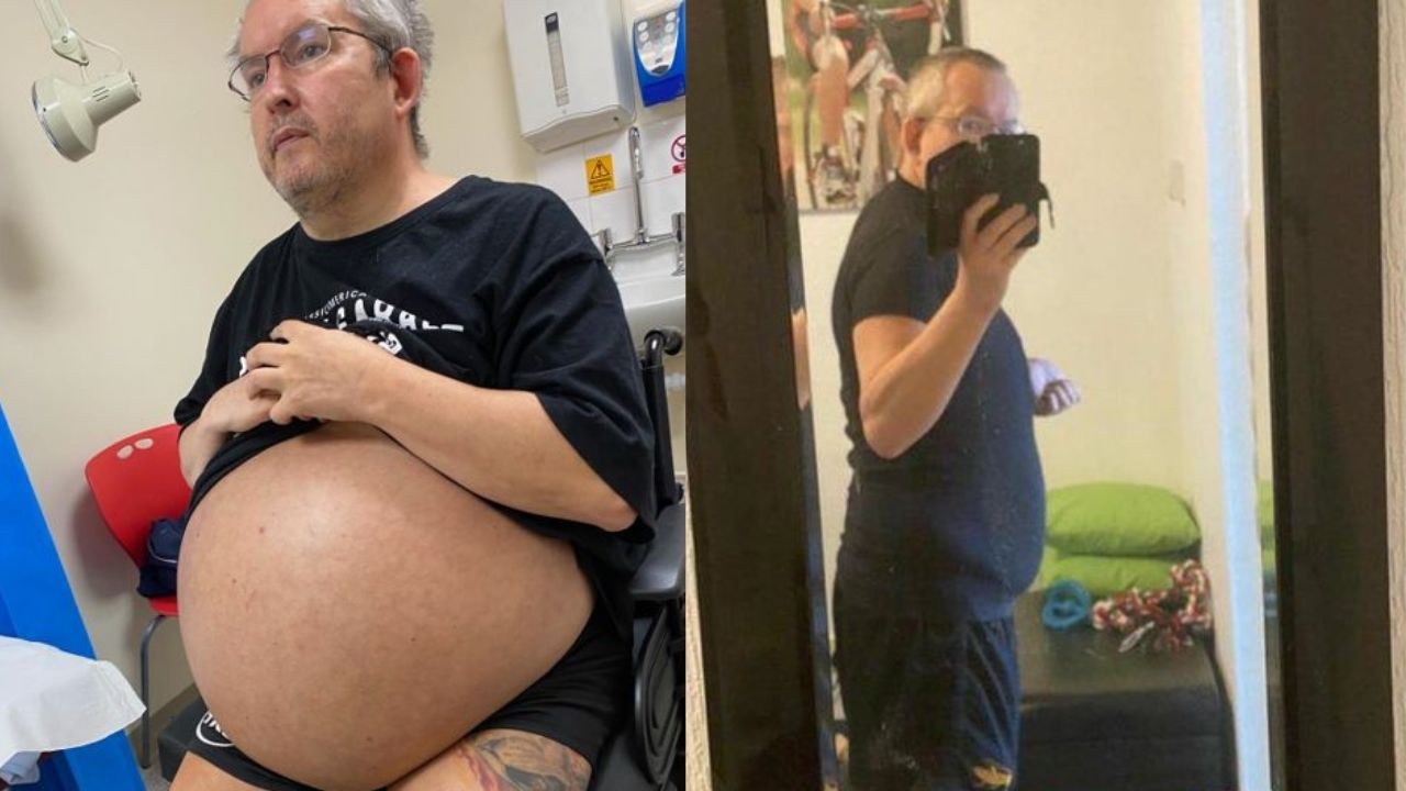 Britânico remove rins e descobre que órgãos tinham mais de 35 kilos