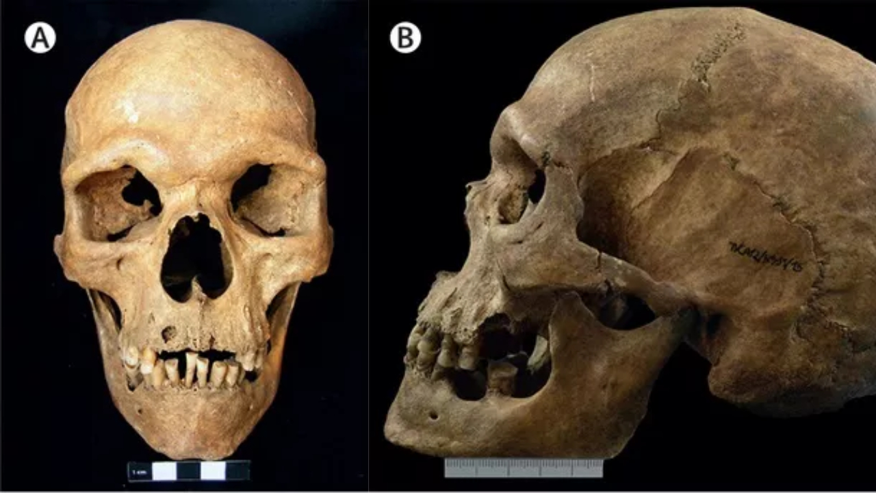 Esqueleto do século 11 é o registro mais antigo de síndrome humana rara