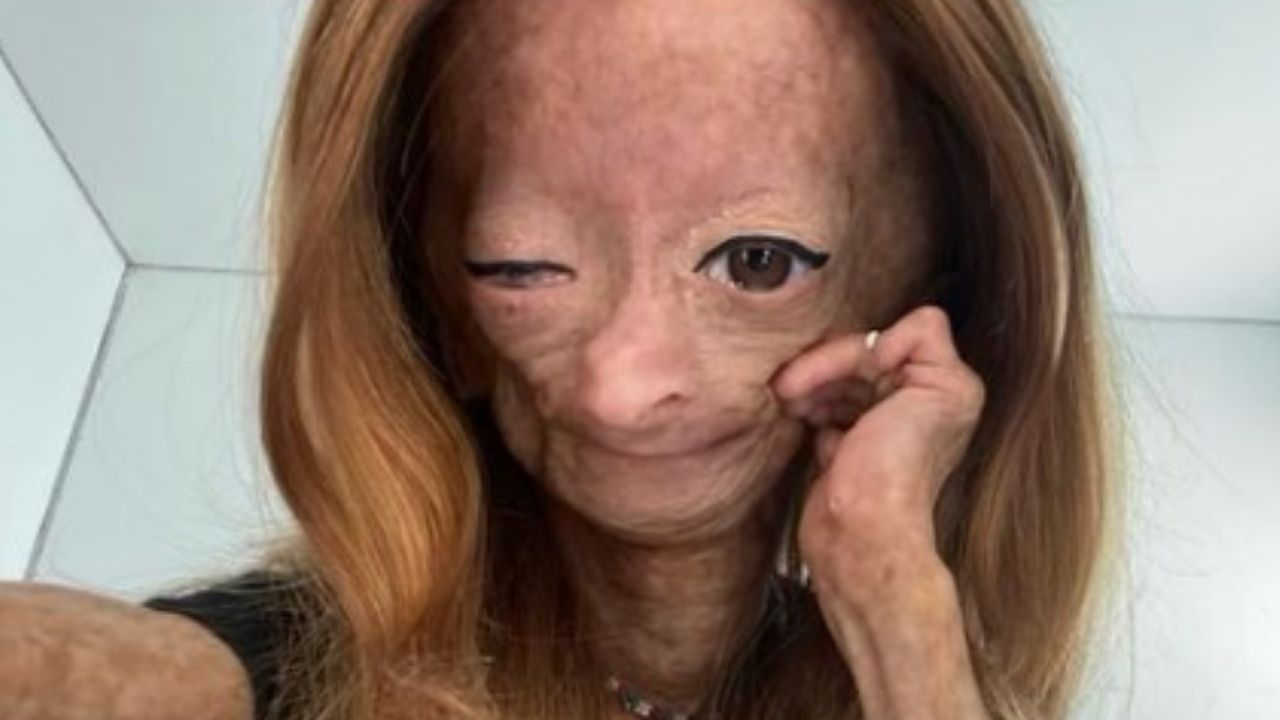 Youtuber com ‘doença de Benjamin Button’ morre aos 15 anos