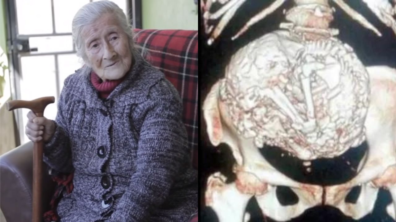 Estela Meléndez: A mulher que viveu mais de 60 anos com feto calcificado na barriga