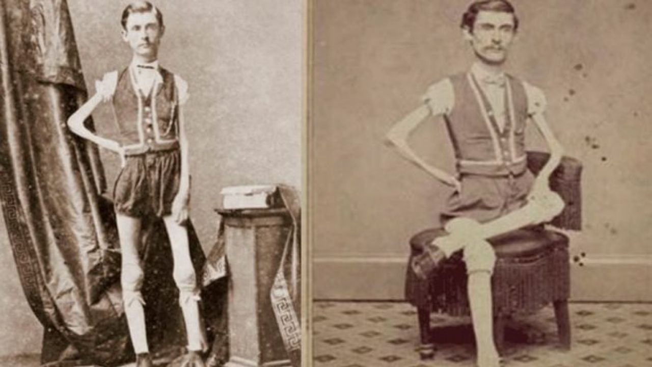 Isaac W. Sprague, a impressionante trajetória do apelidado “esqueleto vivo”