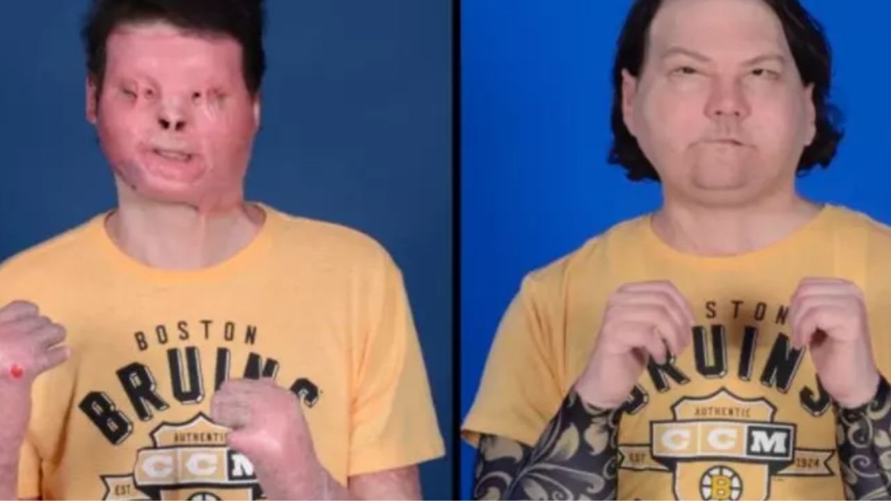 Joe Dimeo: a impressionante história do primeiro transplante bem-sucedido de face e mãos