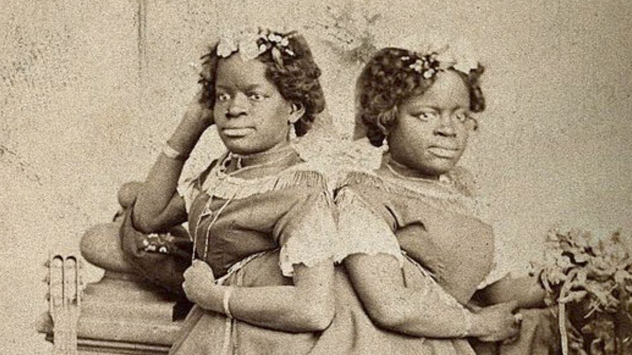 Conheça as irmãs siamesas Millie e Christine McKoy
