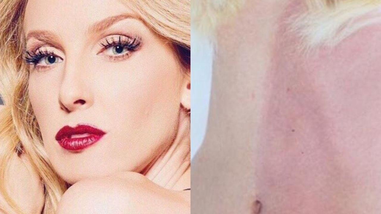 A mulher que é a própria irmã gêmea: os dois tons de pele de Taylor Muhl