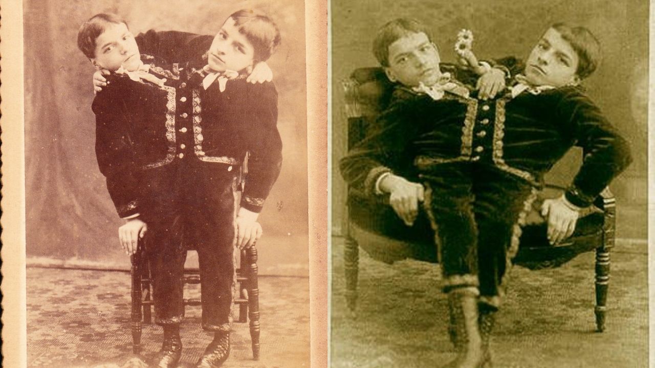 Exames e exposições públicas: a trajetória dos irmãos siameses Tocci