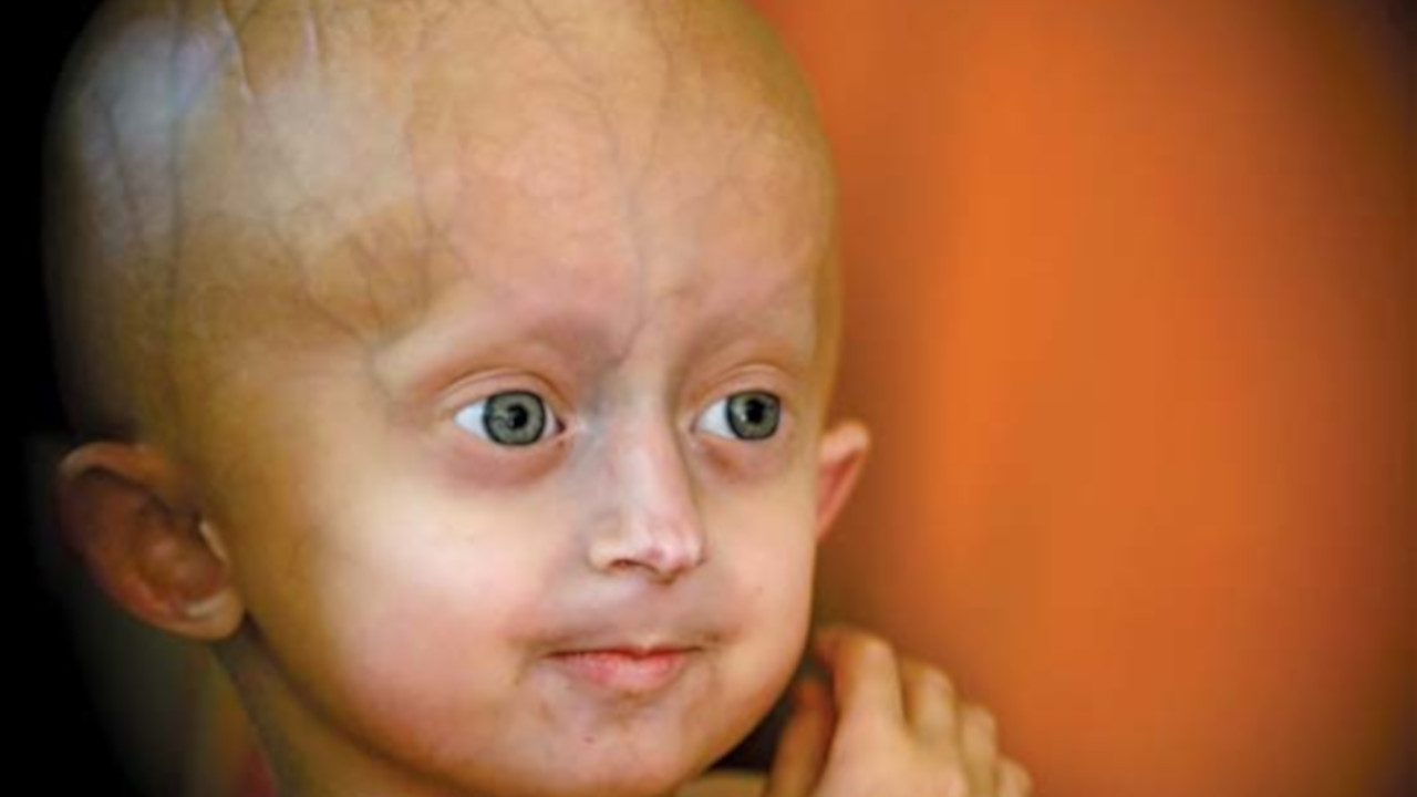 Progeria: a trágica doença das crianças idosas
